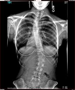 Amanda-Scoliosis